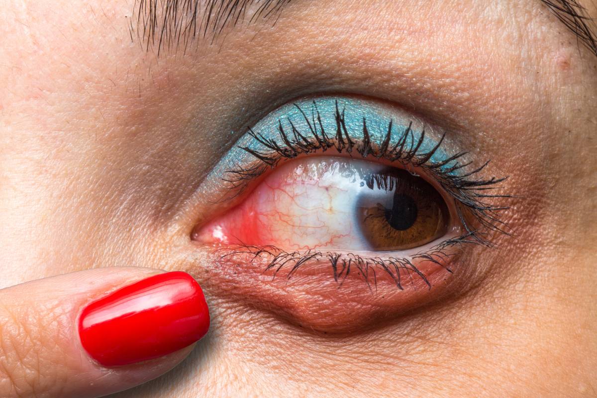 Macro of a makeup eye of a woman suffering from chalazion, finger with red nail polish indicating redness and swelling of the eye